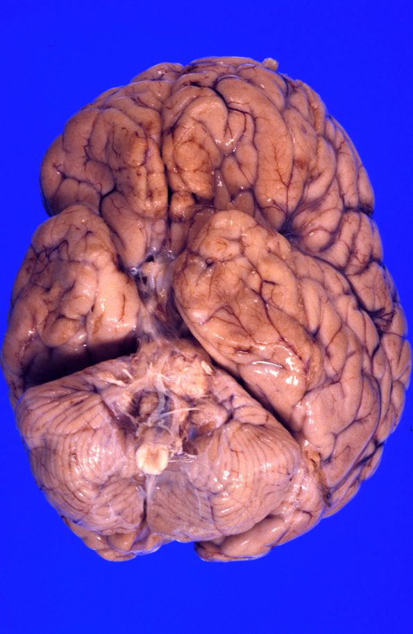 3A4 Mucopolysaccharidosis, Hurler Dz (Case 3) 7