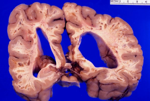 3A6 Mucopolysaccharidosis, Hurler Dz (Case 3) 2