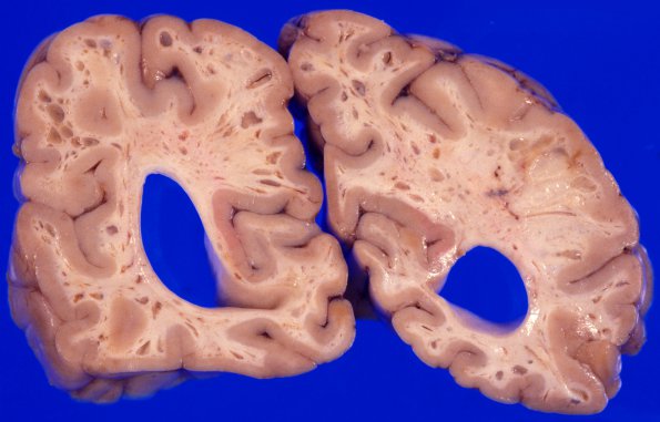 3A7 Mucopolysaccharidosis, Hurler Dz (Case 3) 5