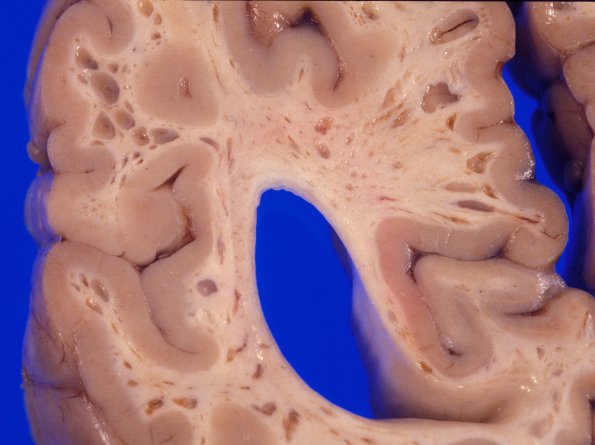 3A8 Mucopolysaccharidosis, Hurler Dz (Case 3) 4