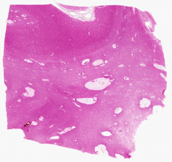 3B1 Mucopolysaccharidosis, Hurler Dz (Case 3)  Occipital H&E whole mount A