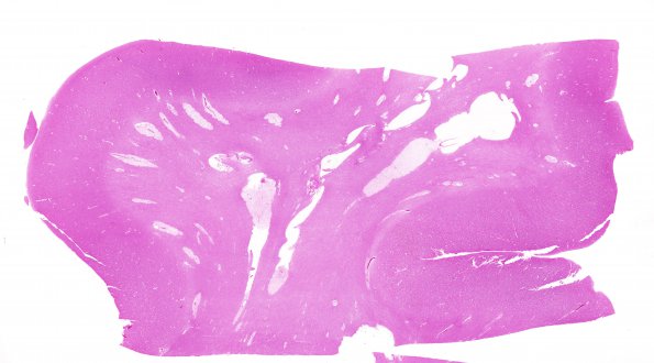 3B2 Mucopolysaccharidosis, Hurler Dz (Case 3) H&E whole mount1 AA