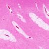 3B3 Mucopolysaccharidosis, Hurler Dz (Case 3) H&E 1