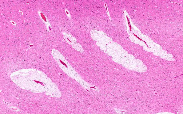 3B3 Mucopolysaccharidosis, Hurler Dz (Case 3) H&E 1