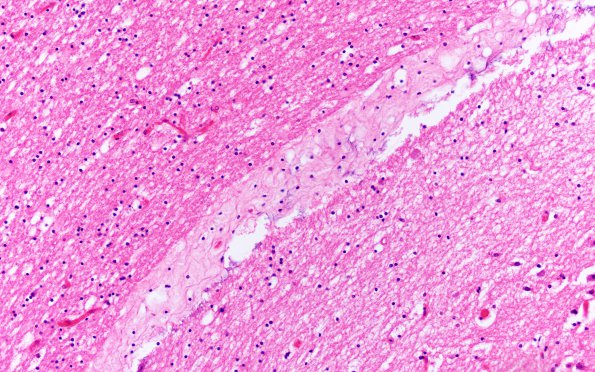 3B4 Mucopolysaccharidosis, Hurler Dz (Case 3) H&E 2