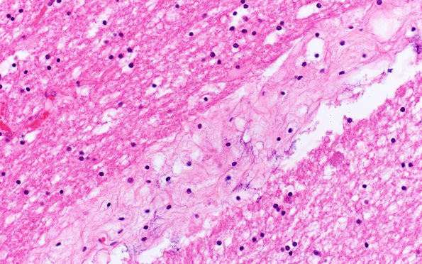 3B5 Mucopolysaccharidosis, Hurler Dz (Case 3) H&E 3