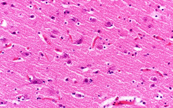 3B6 Mucopolysaccharidosis, Hurler Dz (Case 3) H&E 5