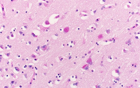 3B8 Mucopolysaccharidosis, Hurler Dz (Case 3) PAS with diastase 1