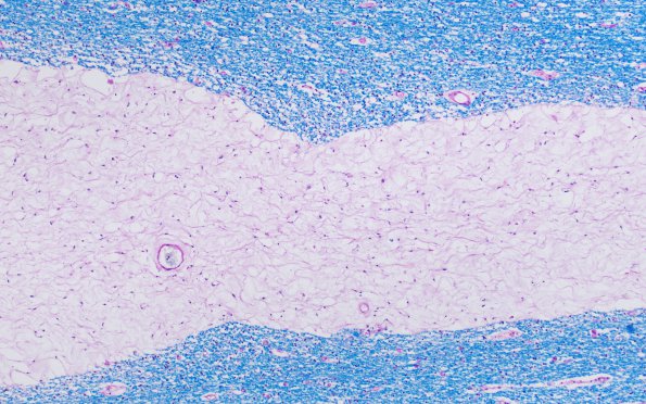 3C2 Mucopolysaccharidosis, Hurler Dz (Case 3) LFB-PAS 3