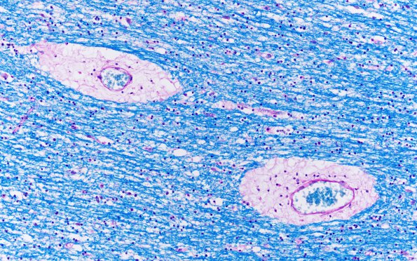 3C3 Mucopolysaccharidosis, Hurler Dz (Case 3) LFB-PAS 2