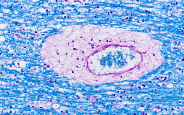 3C4 Mucopolysaccharidosis, Hurler Dz (Case 3) LFB-PAS 1