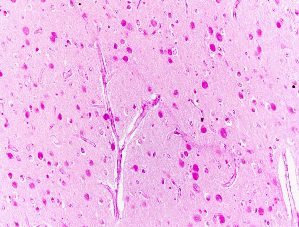 4A Mucopolysaccharidosis (Hurler, Case 4) H&E (vs PAS) 1