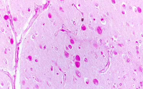 4B Mucopolysaccharidosis (Hurler, Case 4)H&E (vs PAS) 2