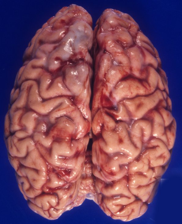 5A1 Mucopolysaccharidosis, Sly type (type VII, Case 5) 4