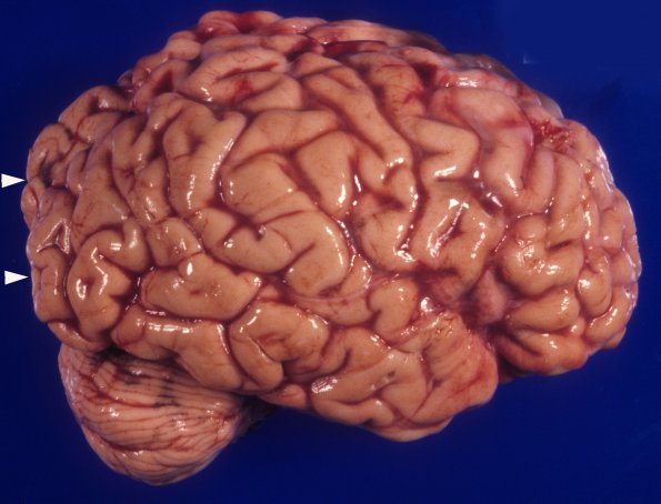 5A2 Mucopolysaccharidosis, Sly type (type VII, Case 5) 3 copy