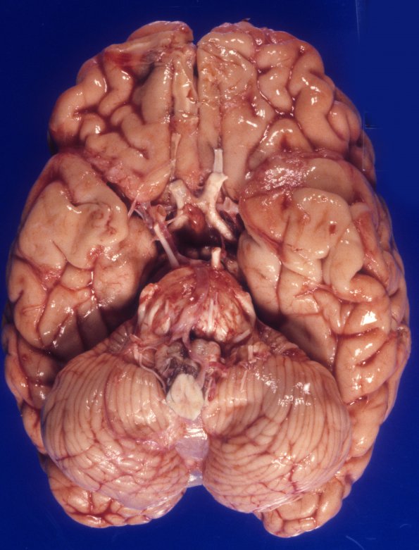 5A3 Mucopolysaccharidosis, Sly type (type VII, Case 5) 2