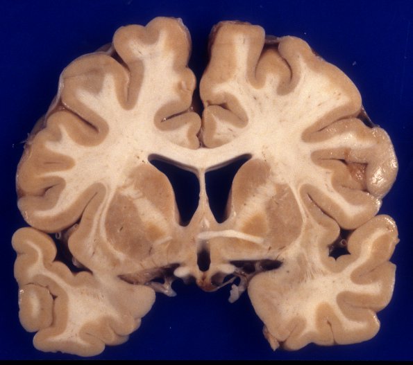 5A4 Mucopolysaccharidosis, Sly type (type VII, Case 5) 1