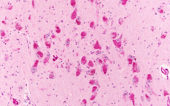 5B10 Mucopolysaccharidosis, Sly type (type VII, Case 5) N6 Substantia Nigra PAS 1