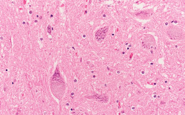 5B11 Mucopolysaccharidosis, Sly type (type VII, Case 5) N8 XII Neurons