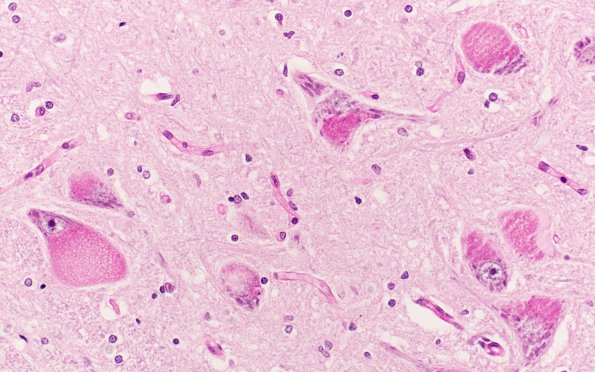 5B12 Mucopolysaccharidosis, Sly type (type VII, Case 5) PAS XII nucleus