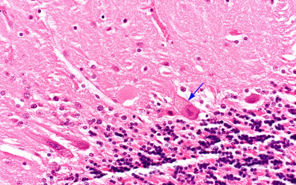 5B13 Mucopolysaccharidosis, Sly type (type VII, Case 5) N9 1 copy