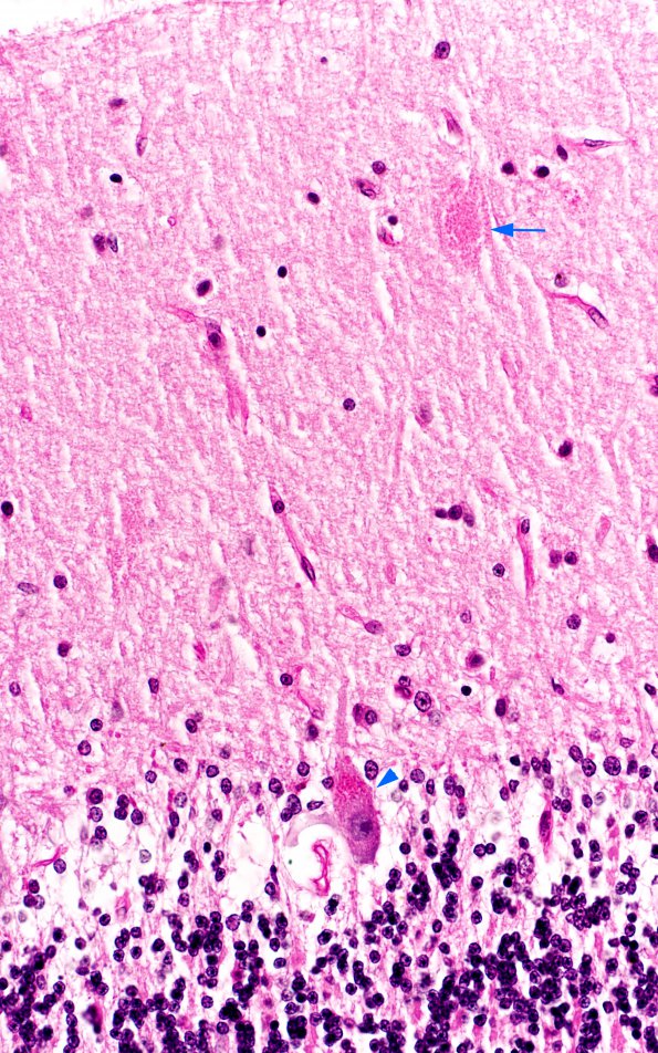 5B14 Mucopolysaccharidosis, Sly type (type VII, Case 5) PAS N9 2 copy