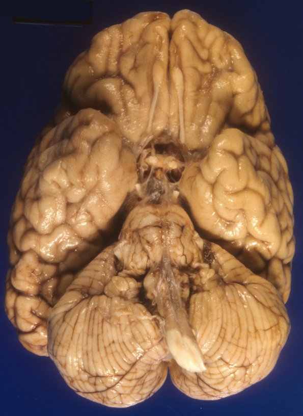 6A1 Mucopolysaccharidosis, Sanfillipo type (Case 6) 2