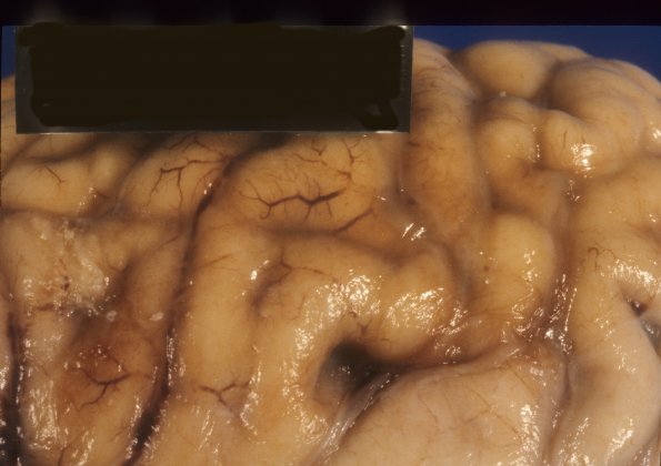 6A2 Mucopolysaccharidosis, Sanfillipo type (Case 6) 3