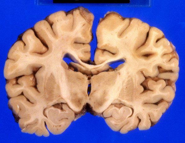 6A3 Mucopolysaccharidosis, Sanfillipo type (Case 6) 1