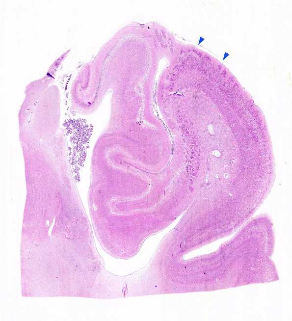 6B2 Mucopolysaccharidosis, Sanfillipo type (Case 6) HC  N5 copy