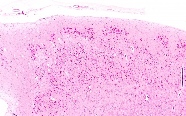 6B3 Mucopolysaccharidosis, Sanfillipo type (Case 6) HC  N5 PAS A2