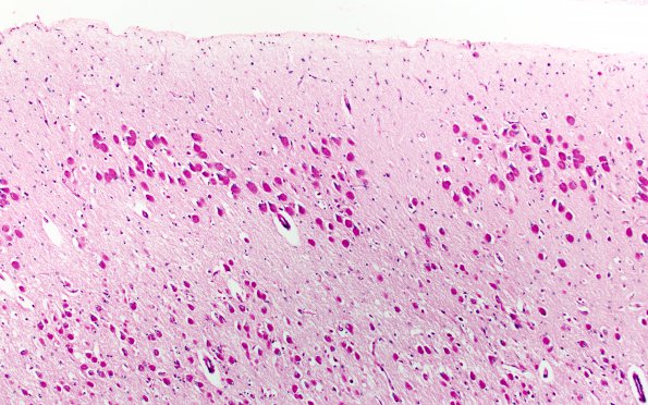 6B4 Mucopolysaccharidosis, Sanfillipo type (Case 6) HC  N5 PAS B2