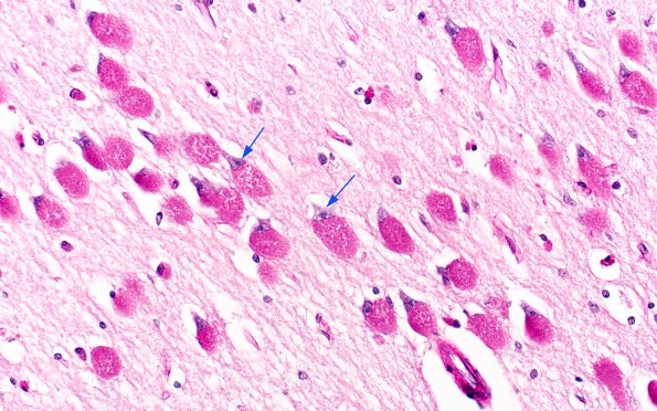 6B5 Mucopolysaccharidosis, Sanfillipo type (Case 6) HC  N5 PAS C2 copy