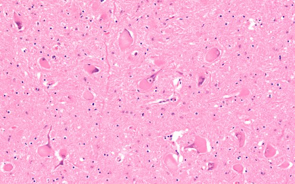 6C1 Mucopolysaccharidosis, Sanfillipo type (Case 6) Medulla N11 Hypoglossal