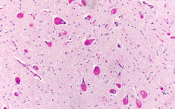 6C2 Mucopolysaccharidosis, Sanfillipo type (Case 6) Medulla, 12th nerve nucleus 2