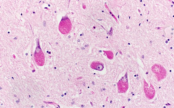 6C3 Mucopolysaccharidosis, Sanfillipo type (Case 6) Medulla, 12th nerve nucleus 1