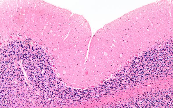 6D1 Mucopolysaccharidosis, Sanfillipo type (Case 6) Cerebellum H&E 4