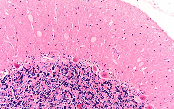 6D2 Mucopolysaccharidosis, Sanfillipo type (Case 6) Cerebellum H&E 1