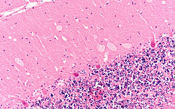 6D3 Mucopolysaccharidosis, Sanfillipo type (Case 6) Cerebellum H&E 7