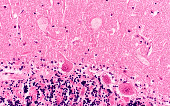 6D4 Mucopolysaccharidosis, Sanfillipo type (Case 6) Cerebellum H&E 3