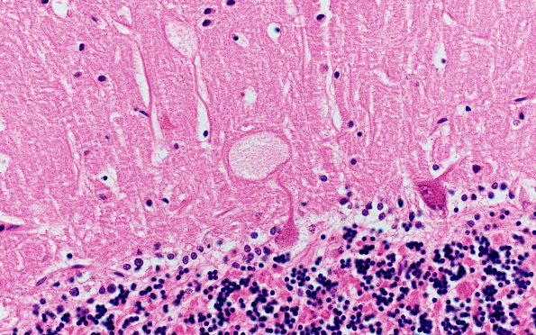 6D5 Mucopolysaccharidosis, Sanfillipo type (Case 6) Cerebellum H&E 5