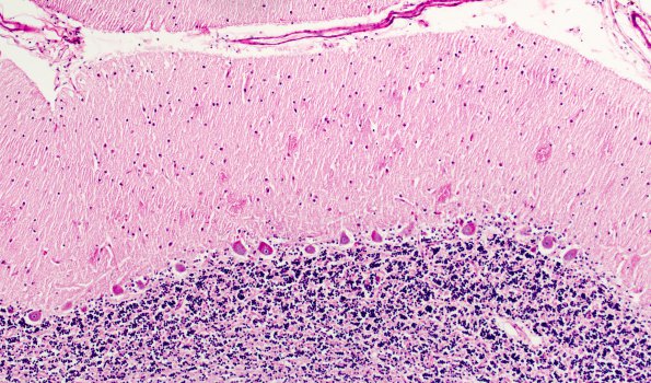 6D6 Mucopolysaccharidosis, Sanfillipo type (Case 6) Cerebellum PAS 2