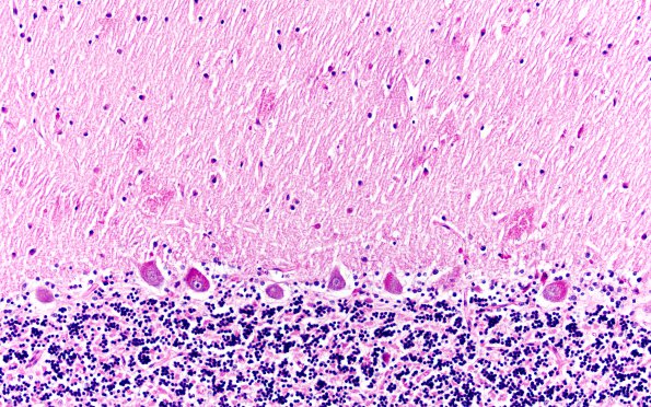 6D7 Mucopolysaccharidosis, Sanfillipo type (Case 6) Cerebellum PAS 3