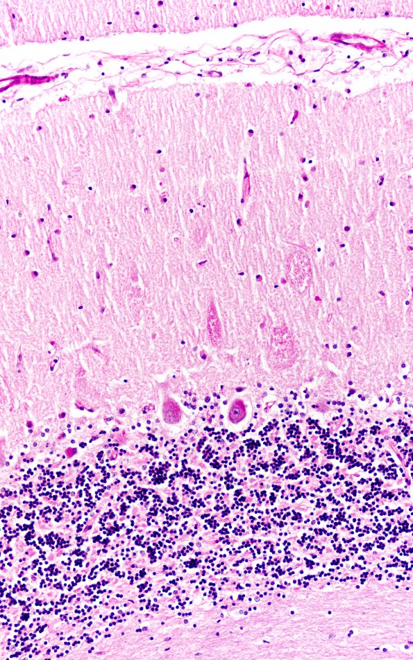 6D8 Mucopolysaccharidosis, Sanfillipo type (Case 6) Cerebellum PAS 4