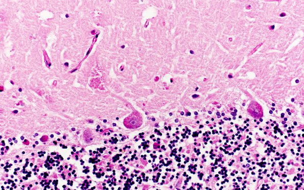 6D9 Mucopolysaccharidosis, Sanfillipo type (Case 6) Cerebellum PAS 5