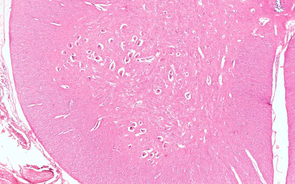 6E1 Mucopolysaccharidosis, Sanfillipo type (Case 6) SC lumbar 2