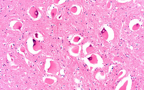 6E2 Mucopolysaccharidosis, Sanfillipo type (Case 6) SC lumbar 1