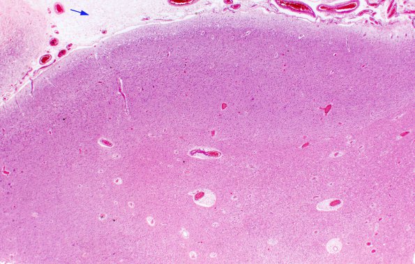 7A1 Mucopolysaccharidosis (WUMS Teaching set) H&E 2x copy