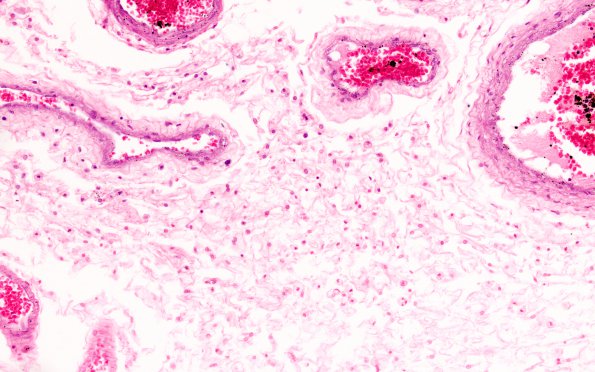 7B1 Mucopolysaccharidosis (WUMS Teaching set) H&E 2 leptomeninges