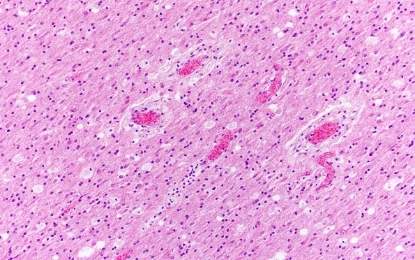 7C1 Mucopolysaccharidosis (WUMS Teaching set) H&E 2